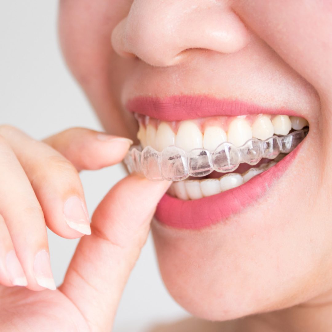 Does Invisalign Take Longer than Other Types of Braces?