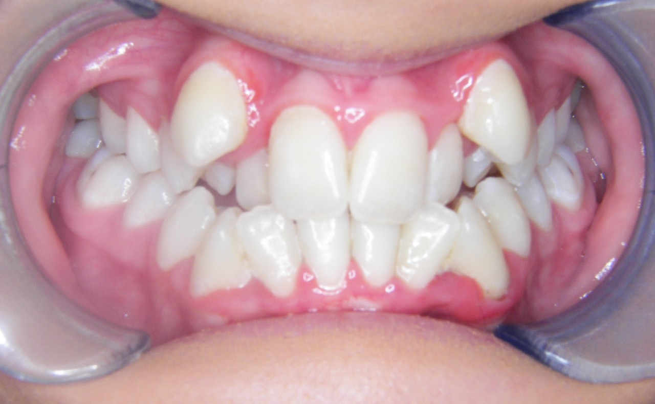 No.1 Lingual Braces - Voted Best Dental Practice in UK