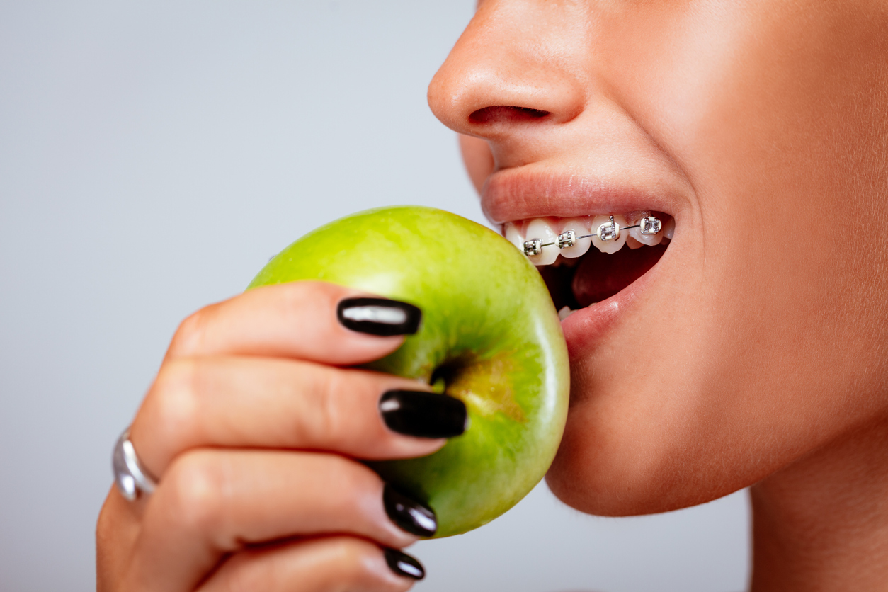 Foods to Avoid if You Have Braces
